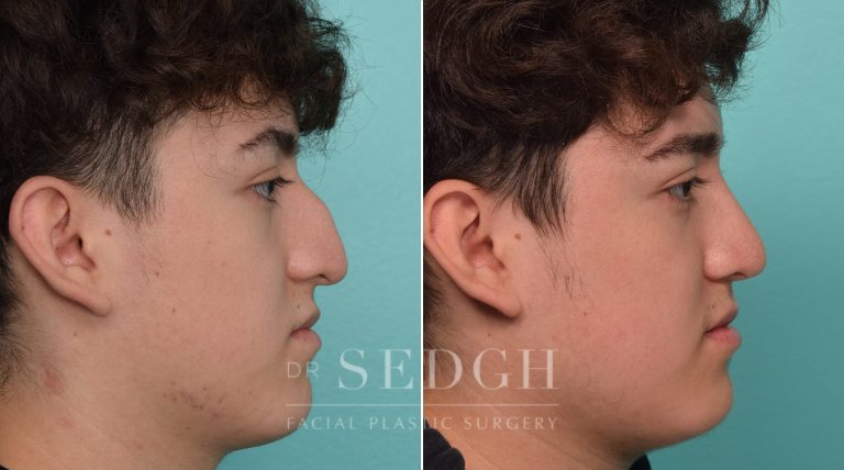 Male Patient Before and After Rhinoplasty | Sedgh