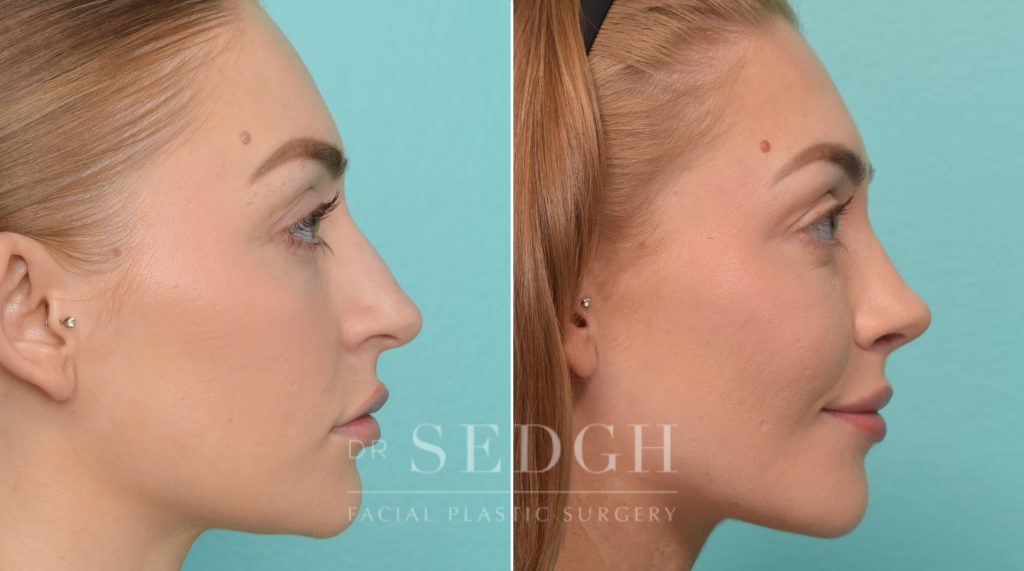 patient before and after rhinoplasty procedure | Sedgh