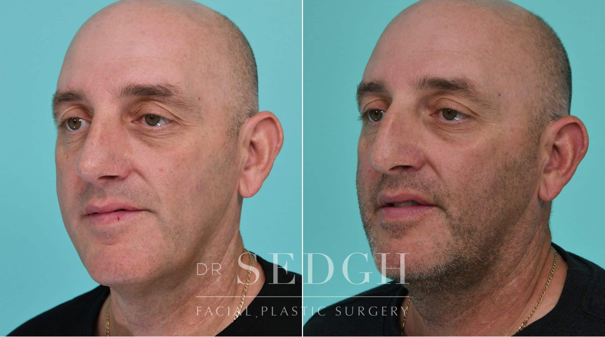 Patient before and after Rhinoplasty | Sedgh