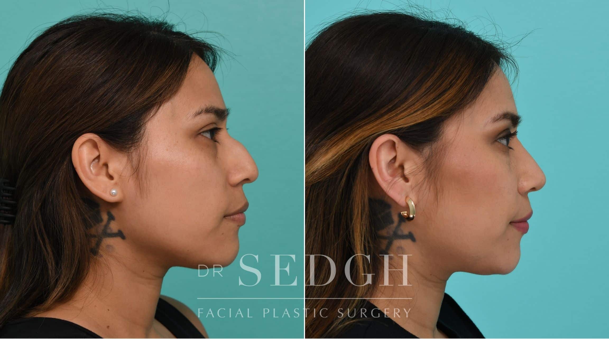 Patient before and after Rhinoplasty | Sedgh