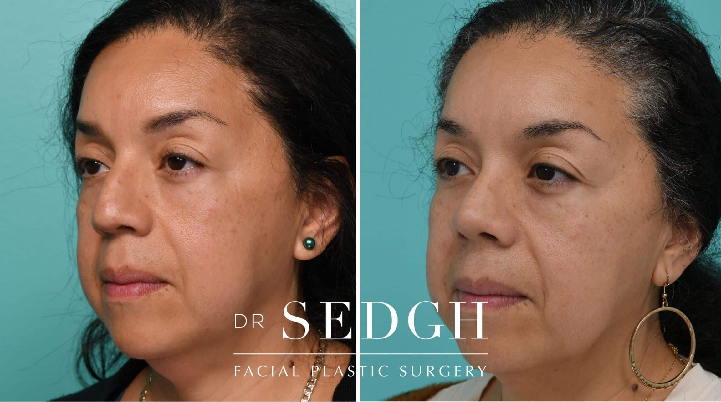 Patient before and after Revision Rhinoplasty | Sedgh