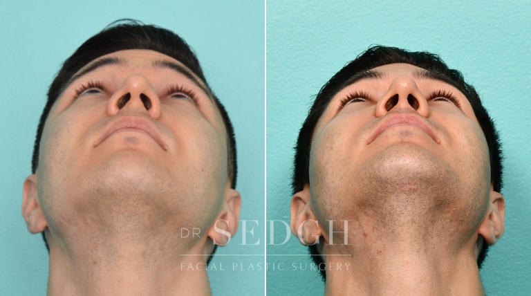 Male Patient Before and After Rhinoplasty | Sedgh