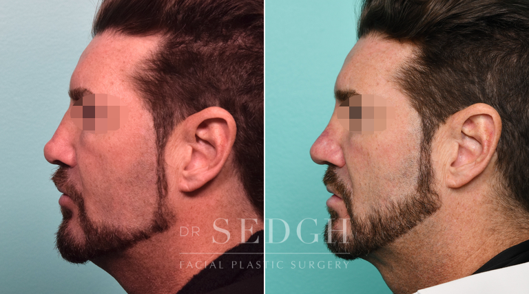 Male Patient Before and After Neck Lipo, Rhinoplasty and Revision Rhinoplasty | Sedgh