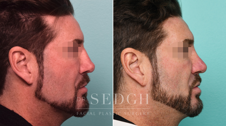 Male Patient Before and After Neck Lipo, Rhinoplasty and Revision Rhinoplasty | Sedgh