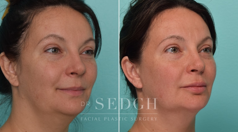 Female Patient Before and After Neck Lipo, FaceTite and Chin Augmentation | Sedgh
