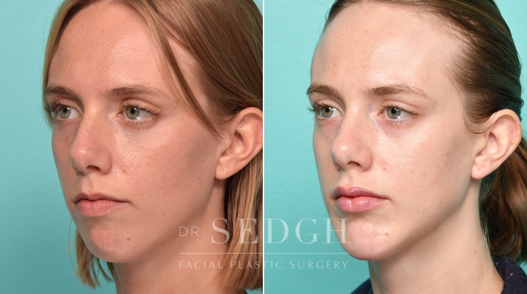 Female Patient Before and After Chin Augmentation | Sedgh