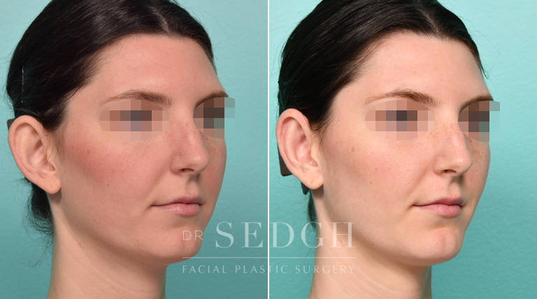 Female Patient Before and After Otoplasty | Sedgh