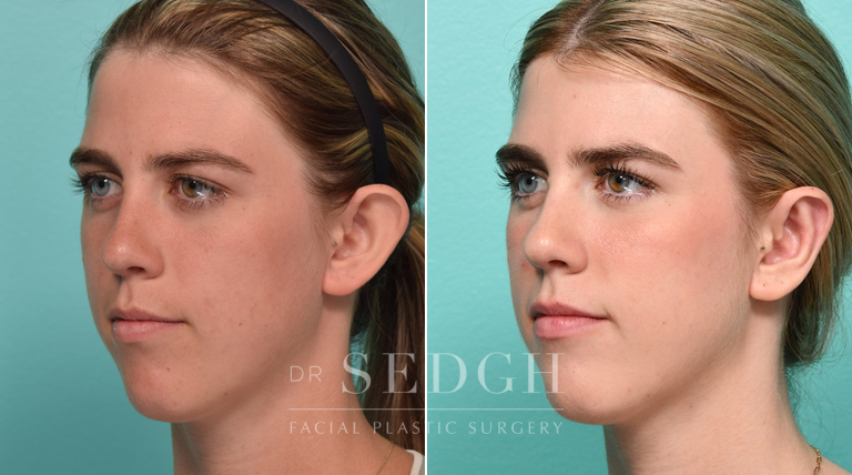 Female Patient Before and After Otoplasty | Sedgh