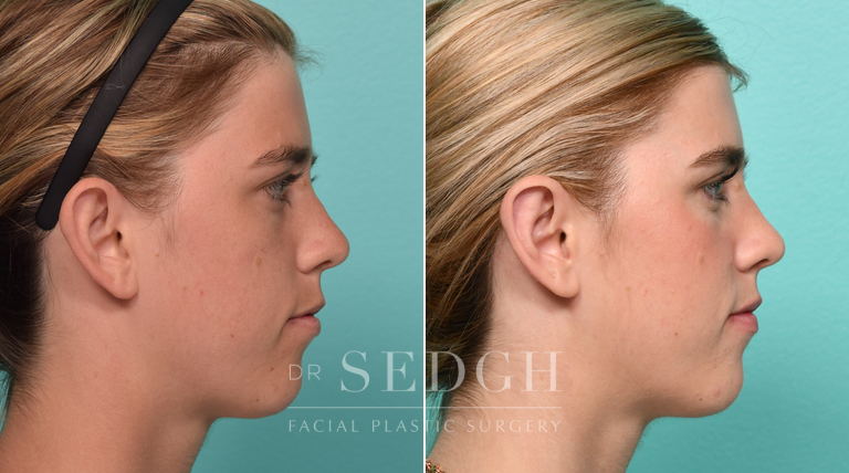 Female Patient Before and After Otoplasty | Sedgh