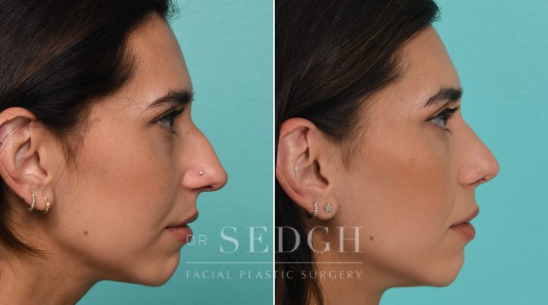 Patient before and after Rhinoplasty | Sedgh