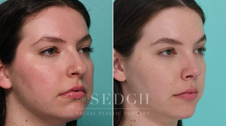 Patient before and after Rhinoplasty | Sedgh