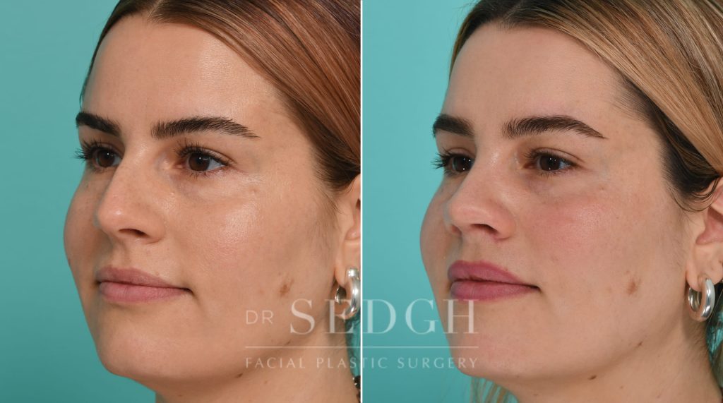 Patient before and after Rhinoplasty | Sedgh