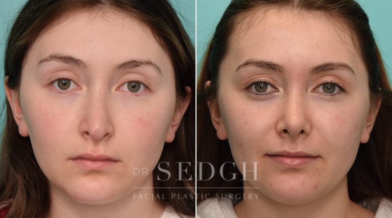 Patient before and after Rhinoplasty | Sedgh