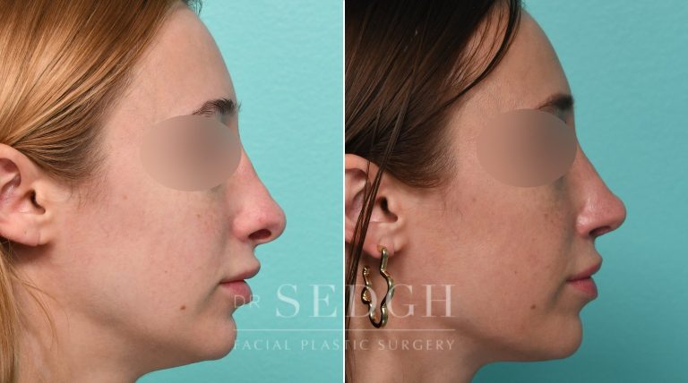 Patient before and after Rhinoplasty | Sedgh