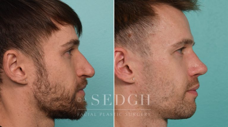 Patient before and after Revision Rhinoplasty | Sedgh