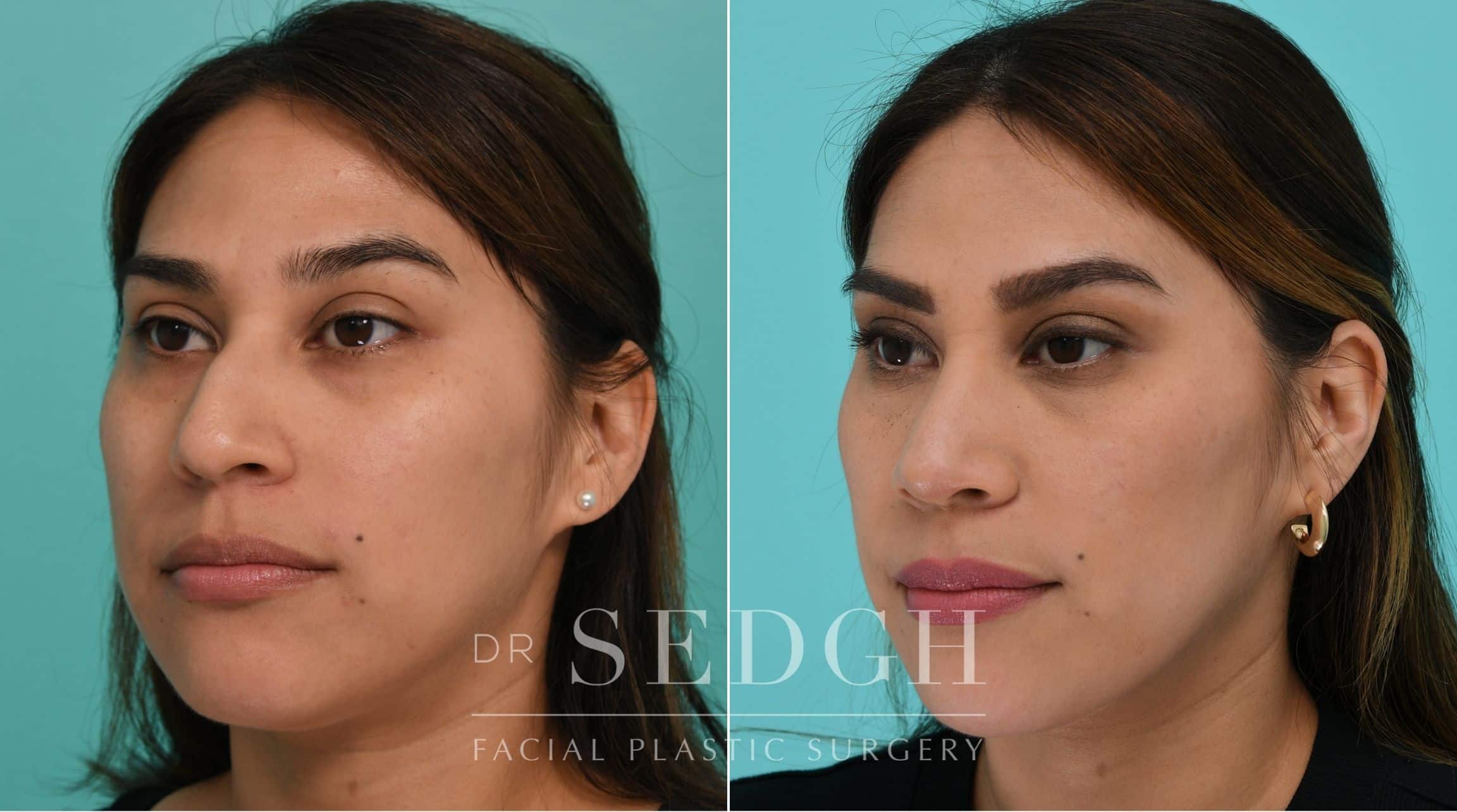 Patient before and after Rhinoplasty | Sedgh