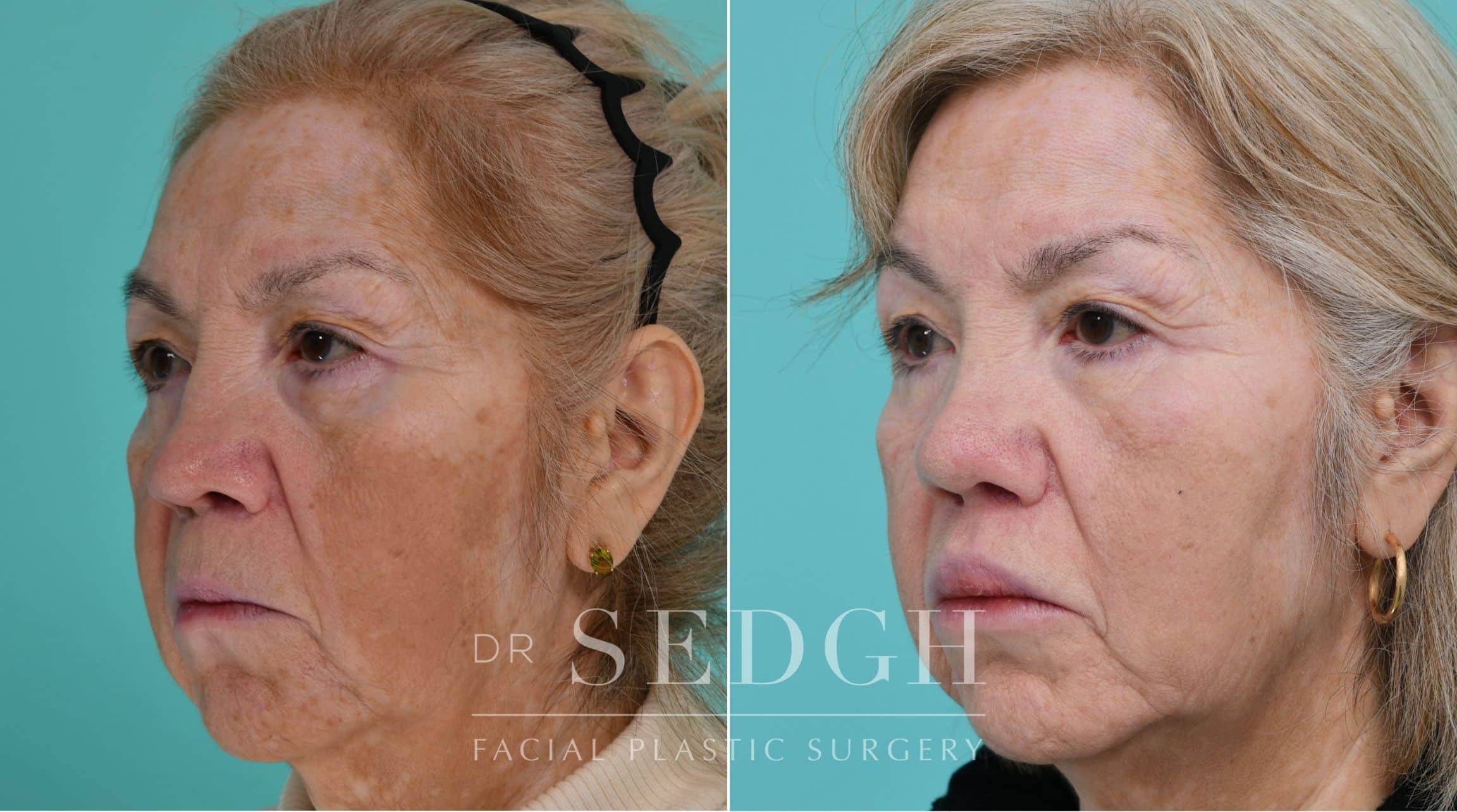 Patient before and after Revision Rhinoplasty | Sedgh