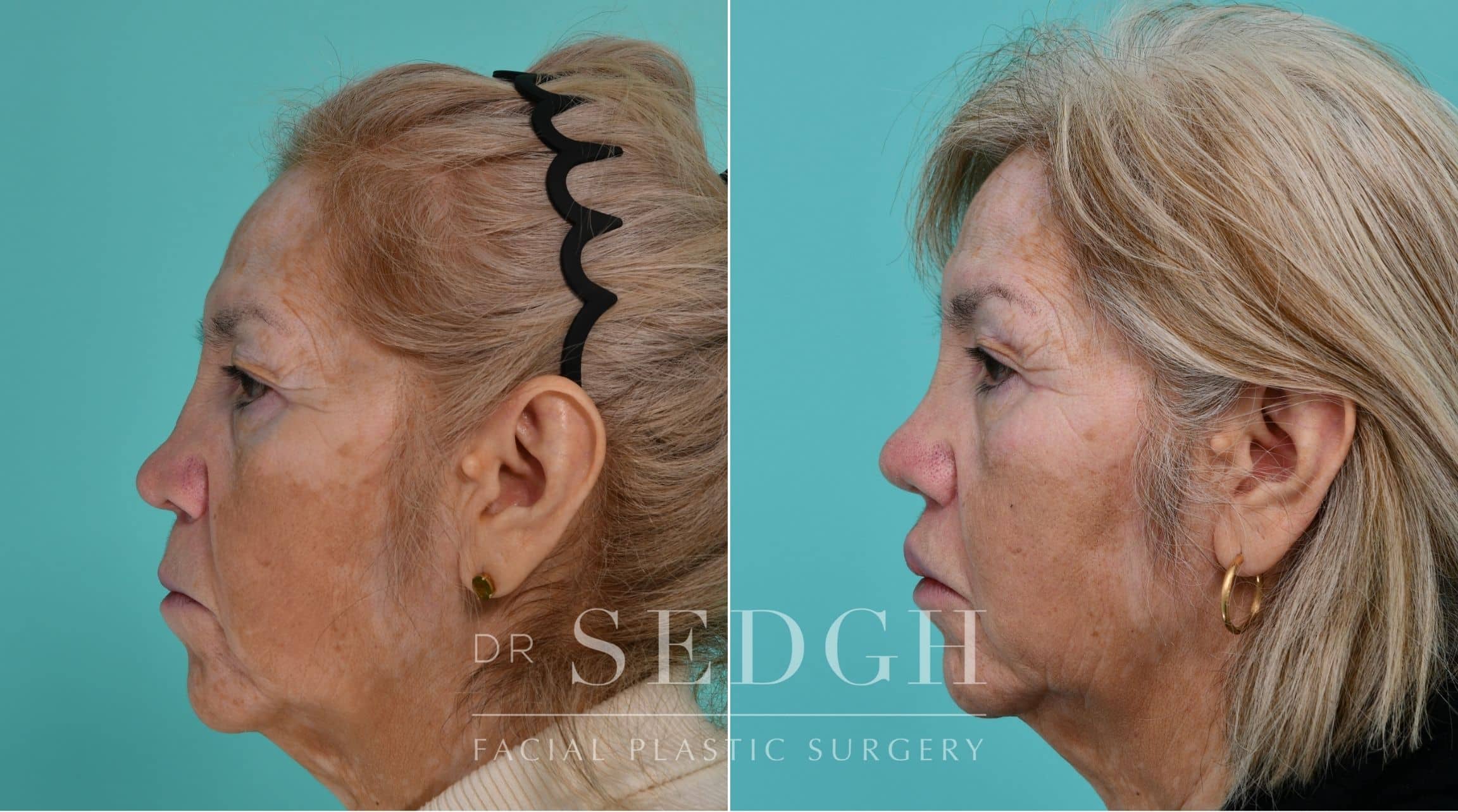 Patient before and after Revision Rhinoplasty | Sedgh
