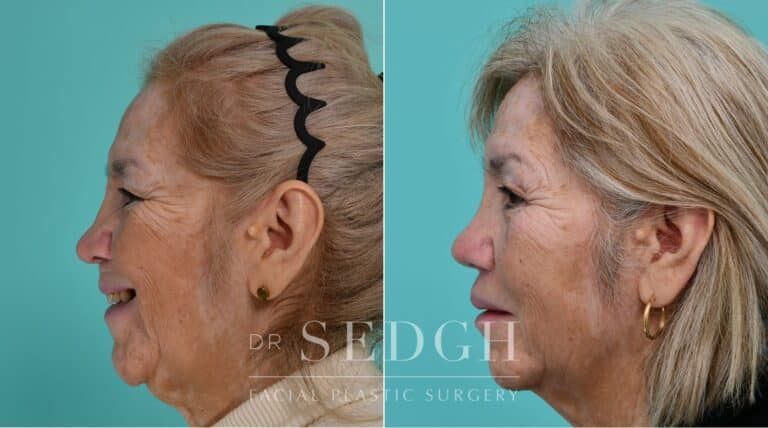 Patient before and after Revision Rhinoplasty | Sedgh