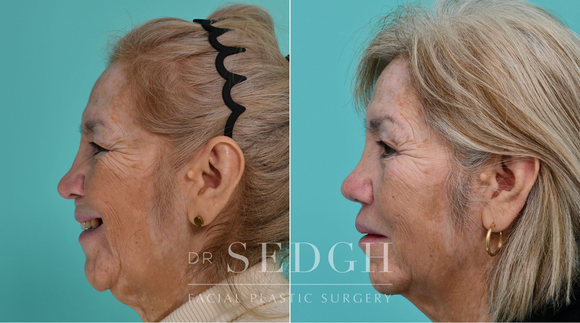 Patient before and after Revision Rhinoplasty | Sedgh