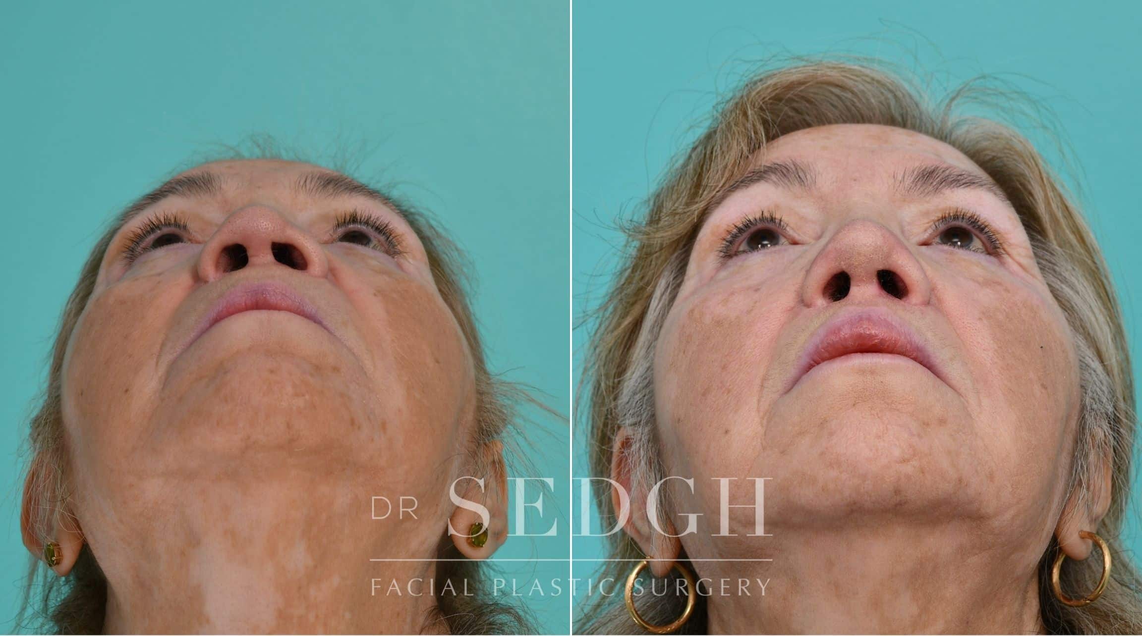 Patient before and after Revision Rhinoplasty | Sedgh