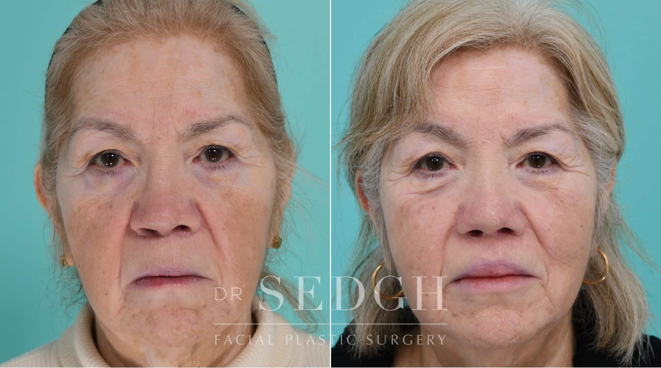 Patient before and after Revision Rhinoplasty | Sedgh