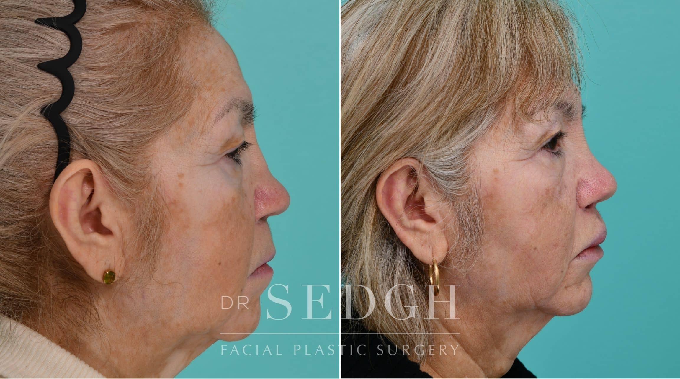 Patient before and after Revision Rhinoplasty | Sedgh