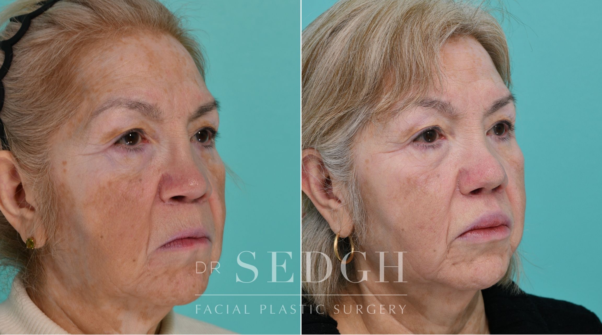 Patient before and after Revision Rhinoplasty | Sedgh