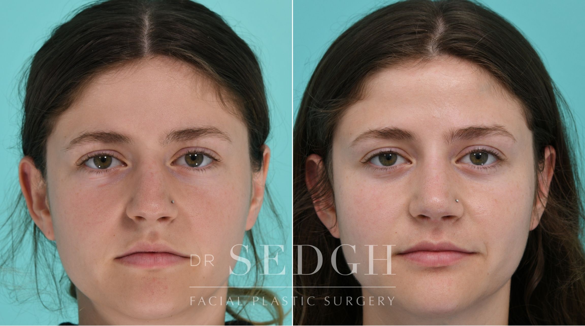 Patient before and after Rhinoplasty | Sedgh