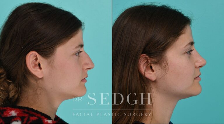 Patient before and after Rhinoplasty | Sedgh