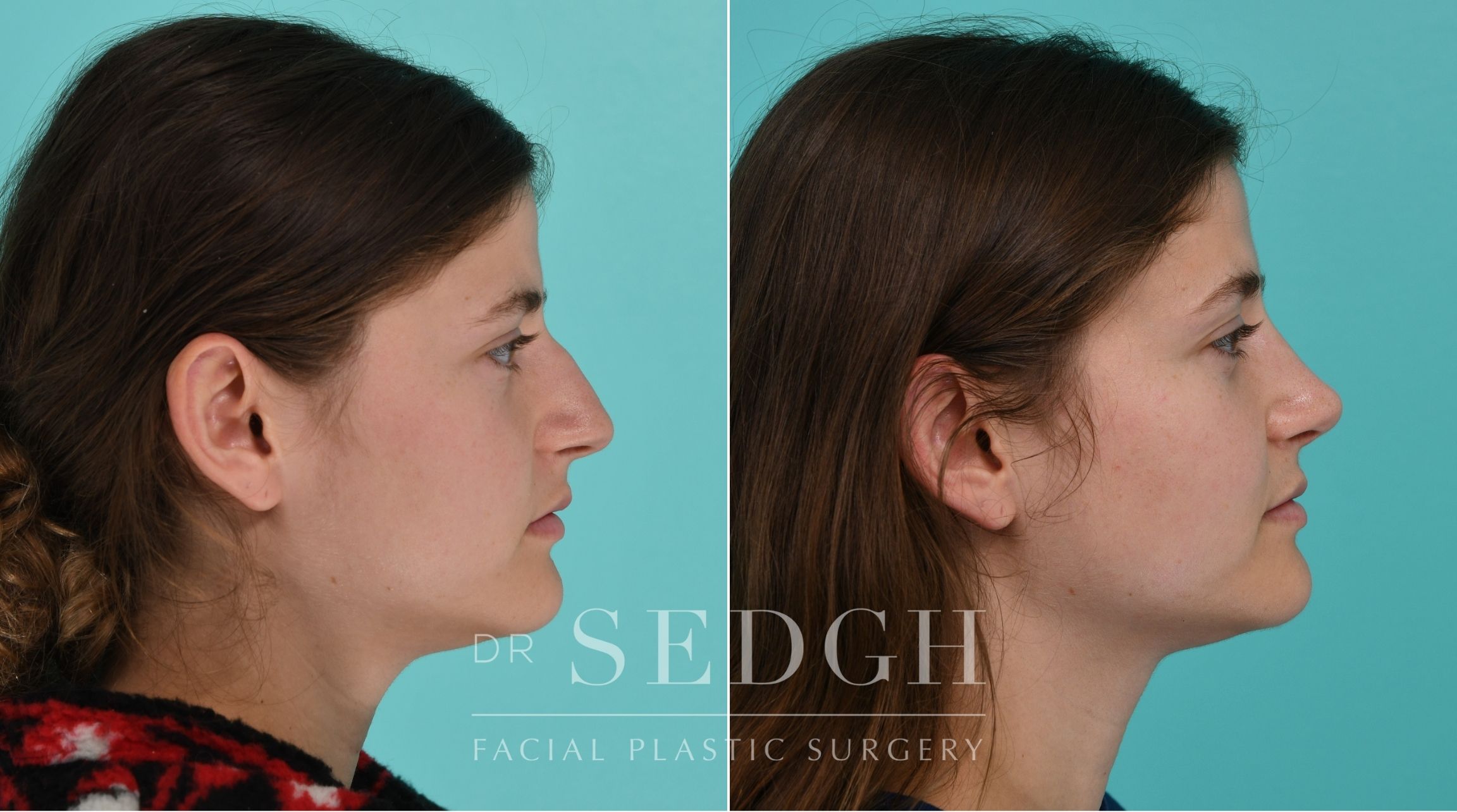 Patient before and after Rhinoplasty | Sedgh