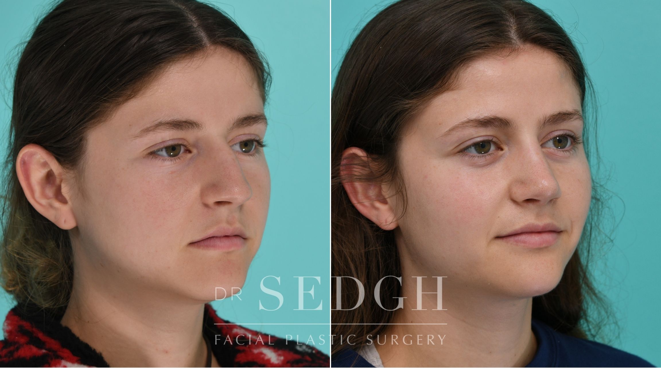 Patient before and after Rhinoplasty | Sedgh