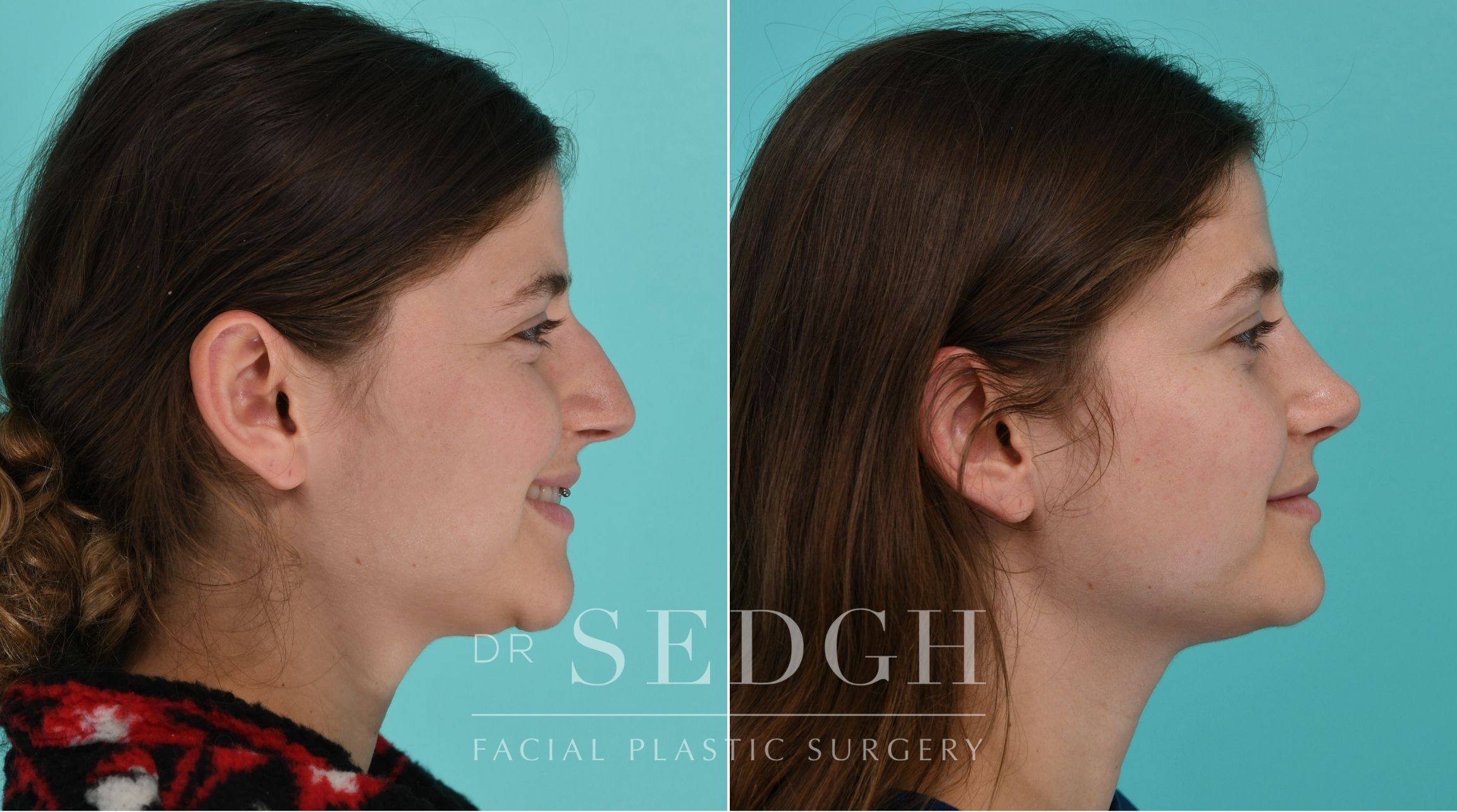 Patient before and after Rhinoplasty | Sedgh