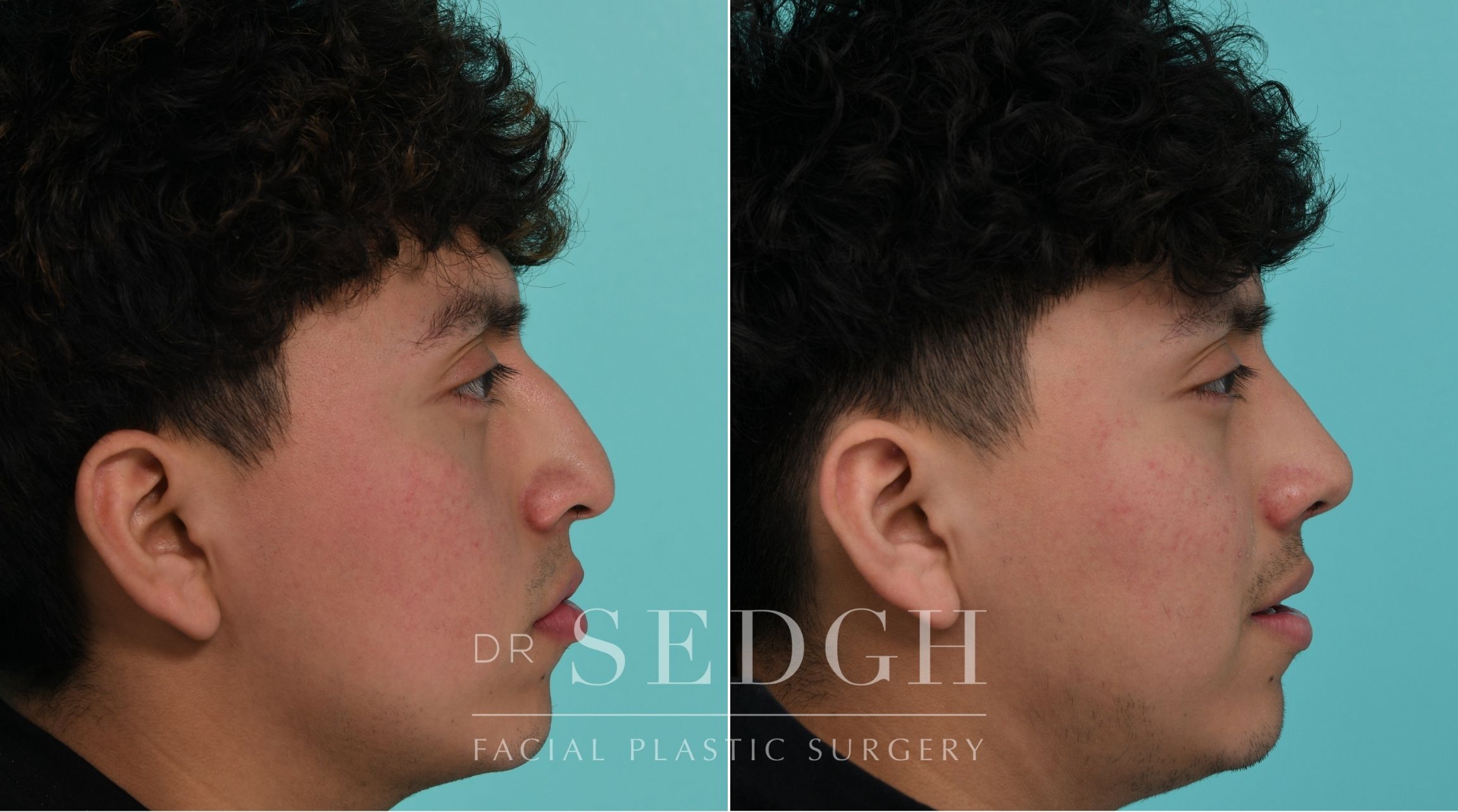 Patient before and after Rhinoplasty | Sedgh