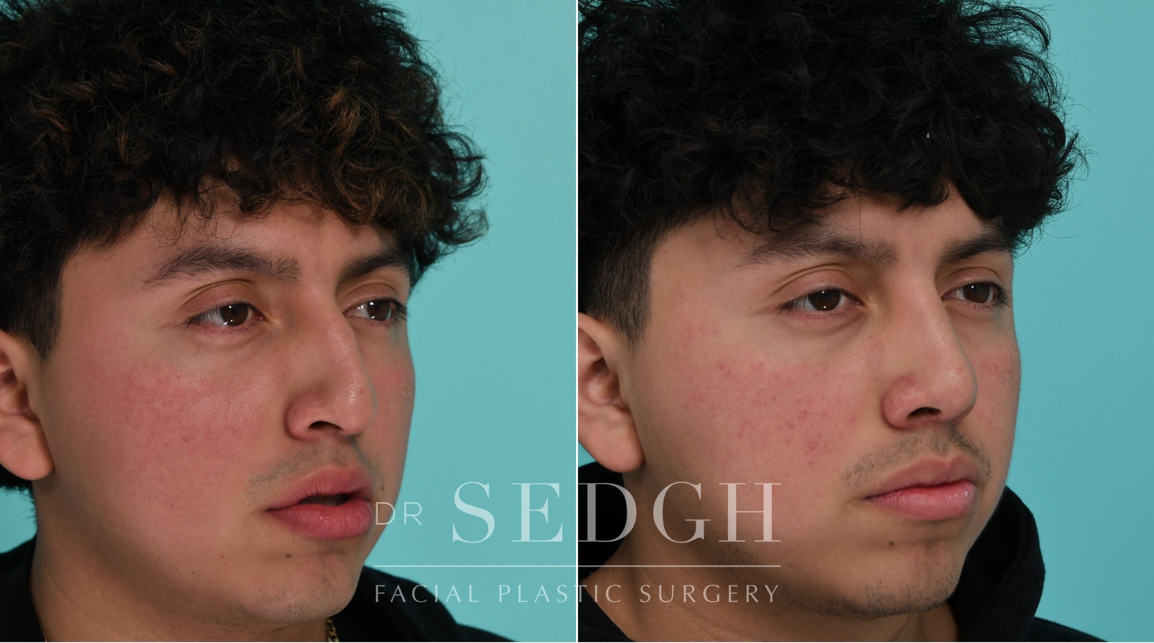 Patient before and after Rhinoplasty | Sedgh
