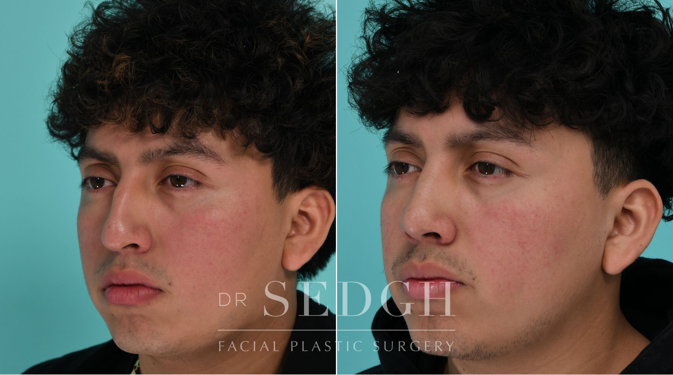 Patient before and after Rhinoplasty | Sedgh