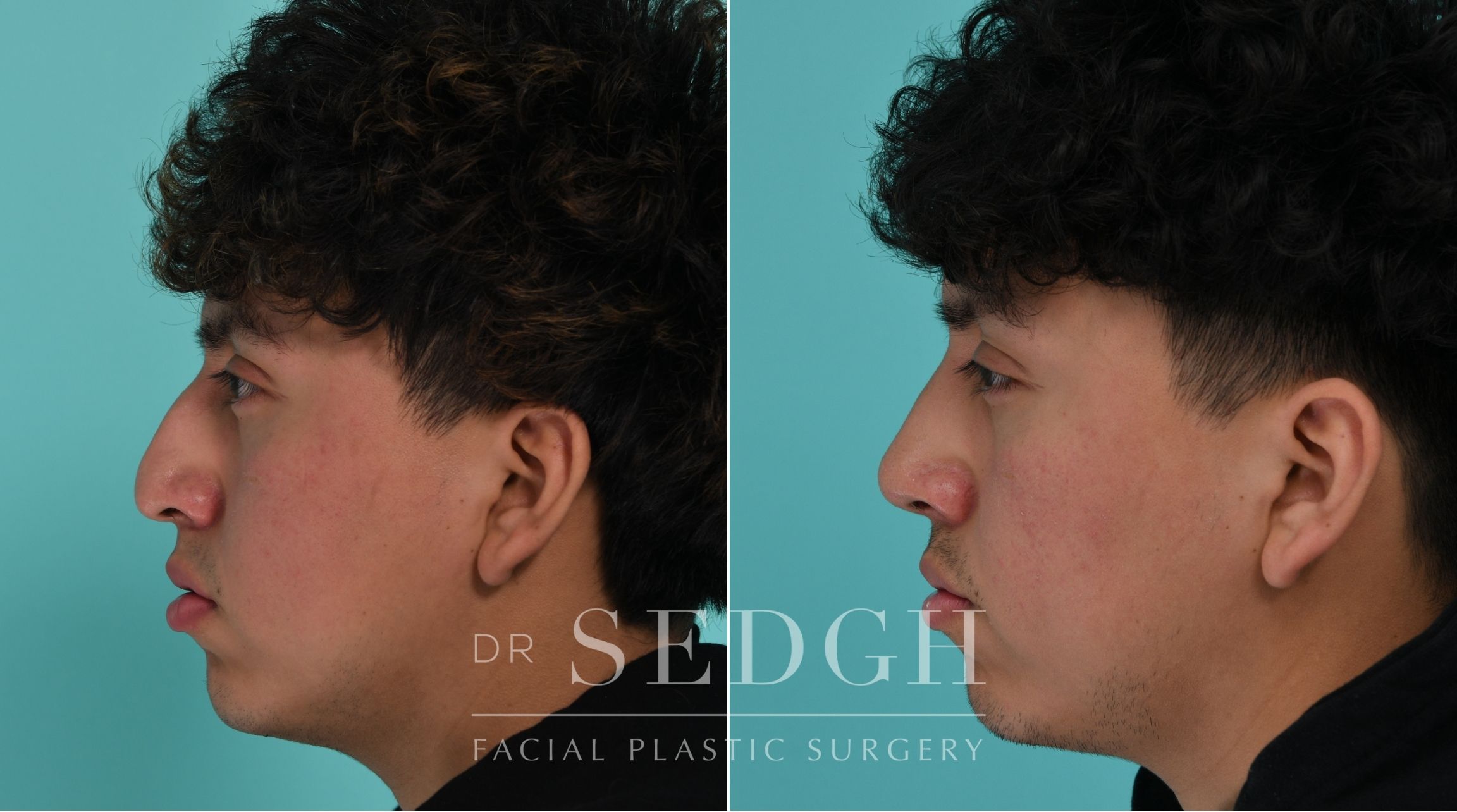 Patient before and after Rhinoplasty | Sedgh