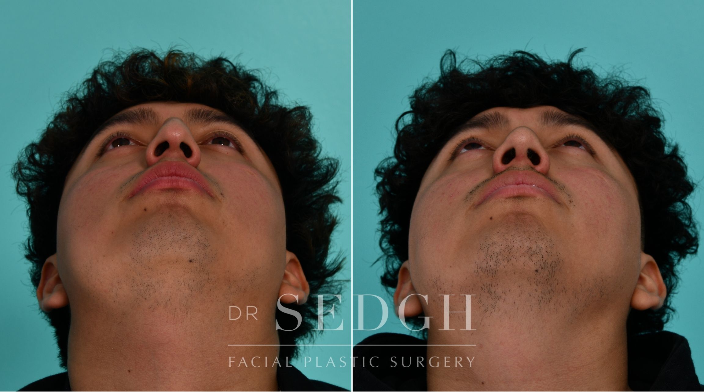 Patient before and after Rhinoplasty | Sedgh