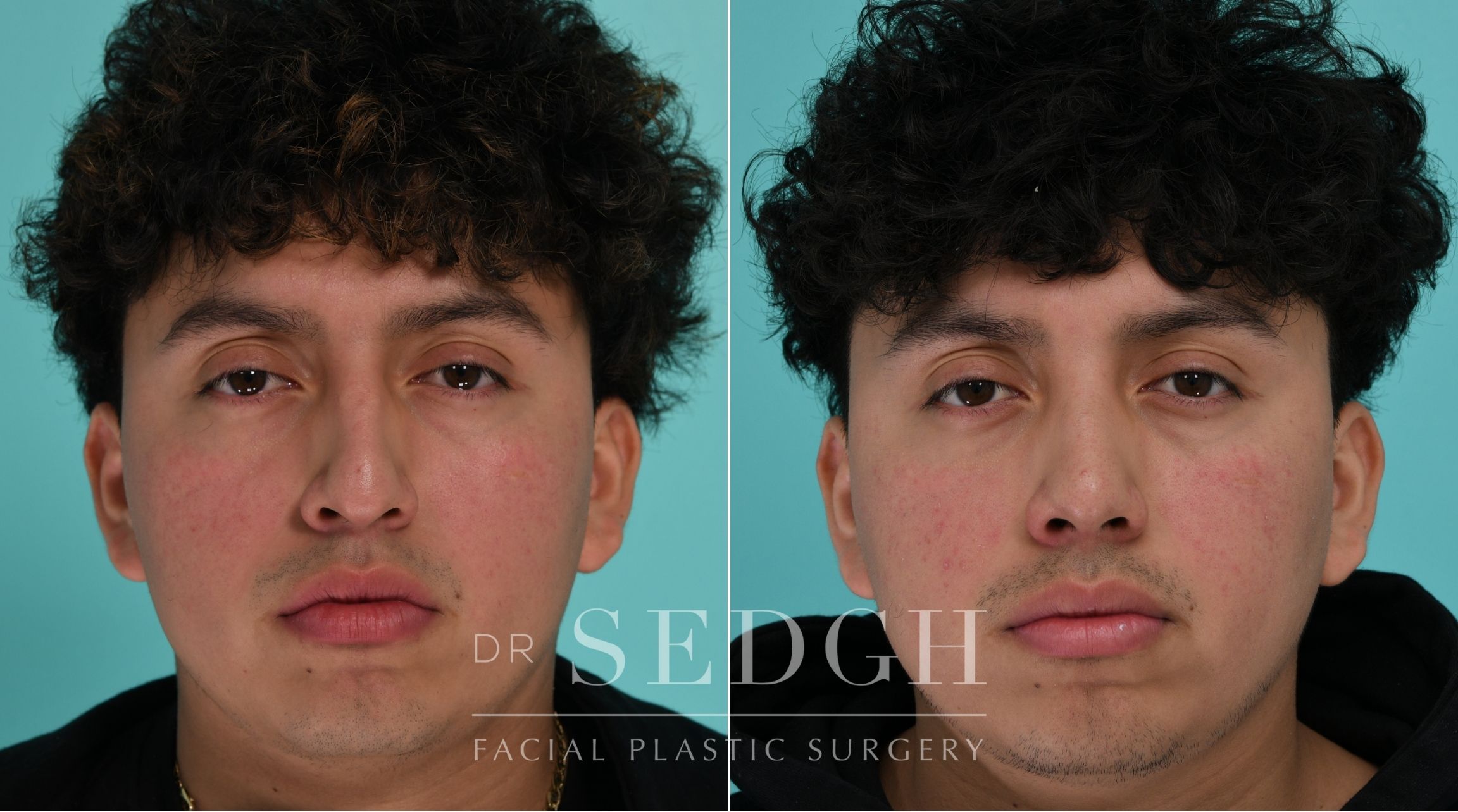 Patient before and after Rhinoplasty | Sedgh