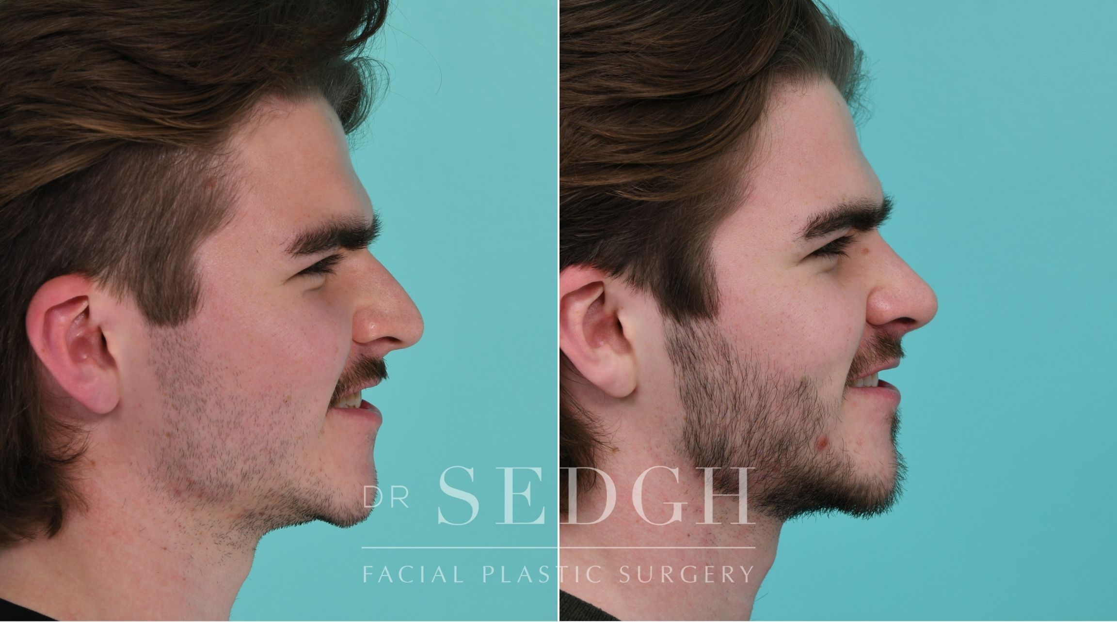 Patient before and after Rhinoplasty | Sedgh