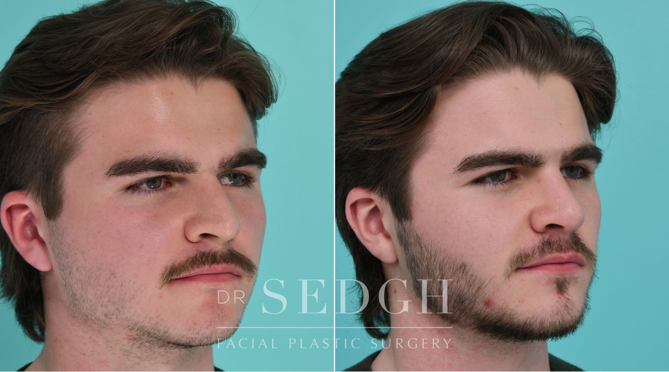 Patient before and after Rhinoplasty | Sedgh