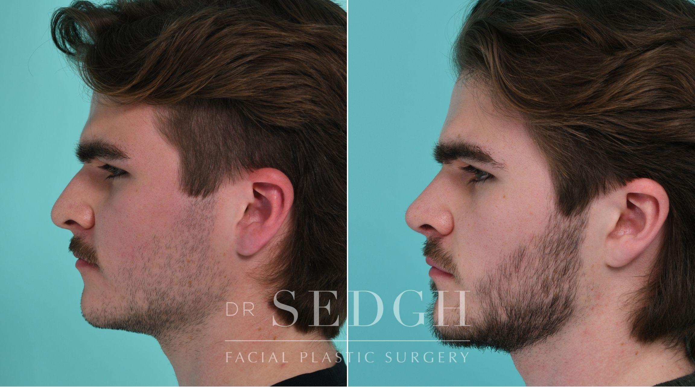 Patient before and after Rhinoplasty | Sedgh