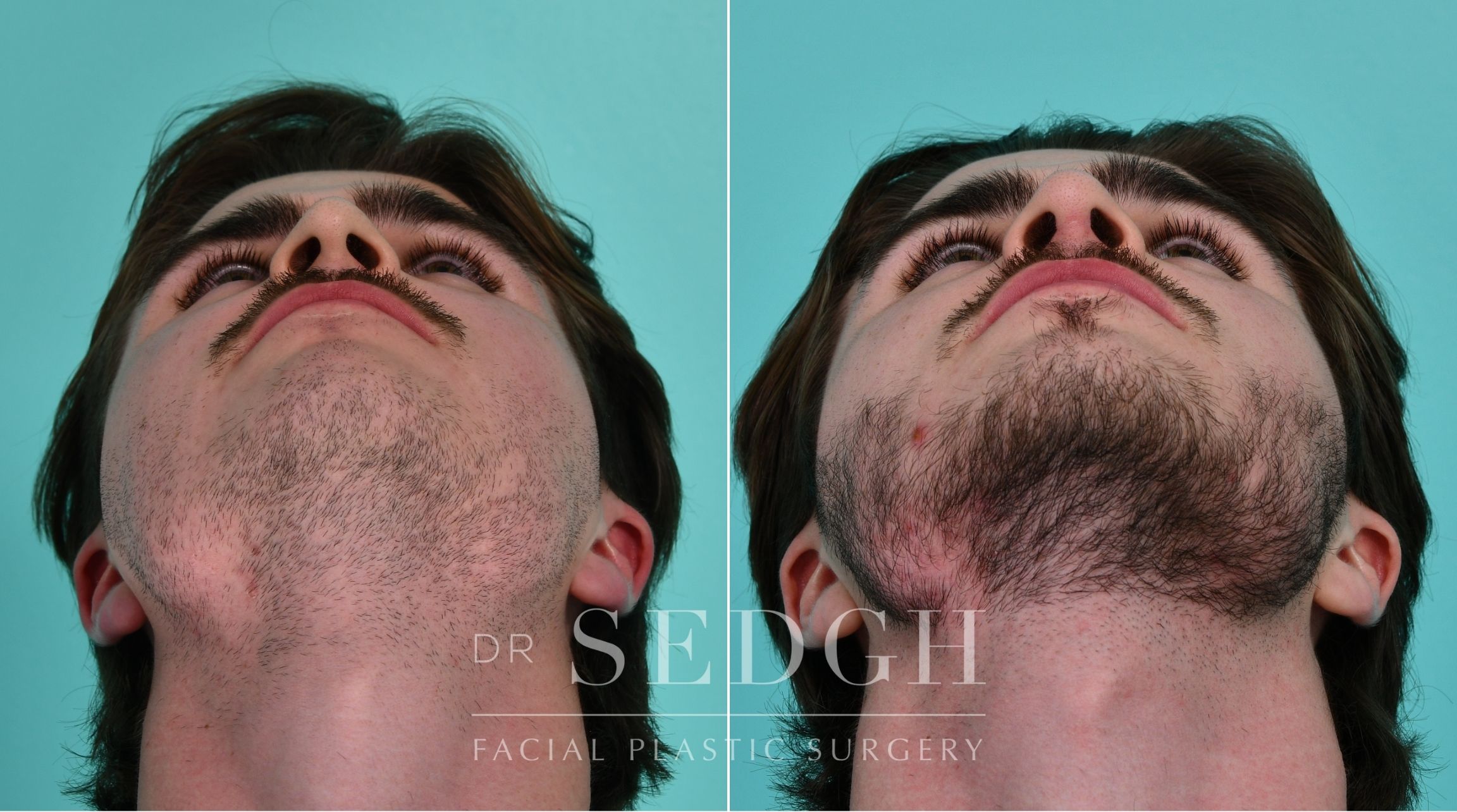 Patient before and after Rhinoplasty | Sedgh