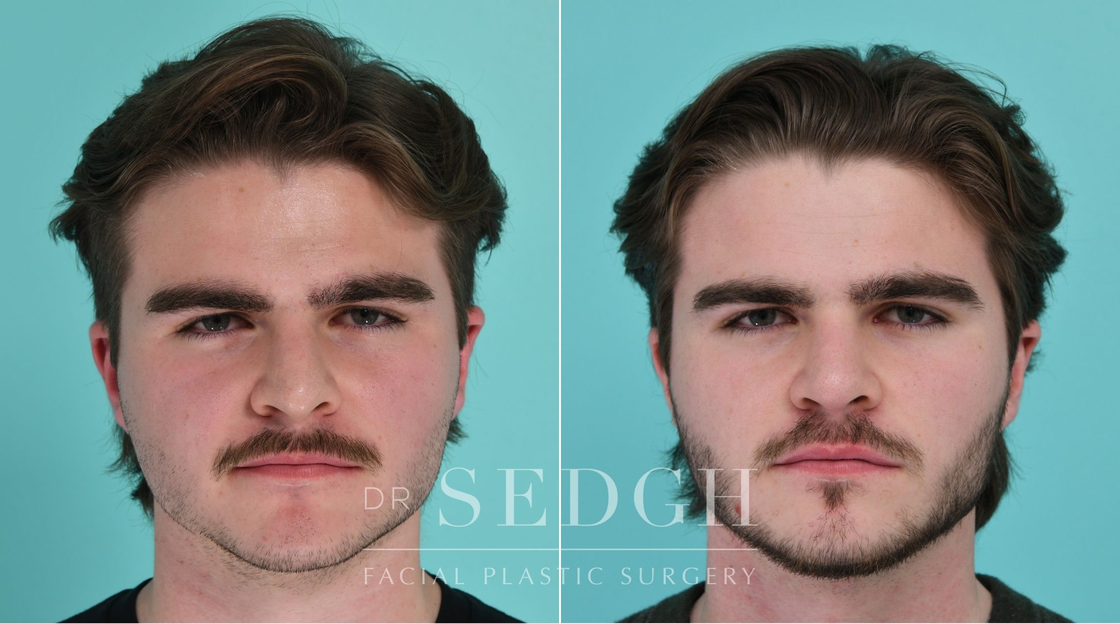 Patient before and after Rhinoplasty | Sedgh