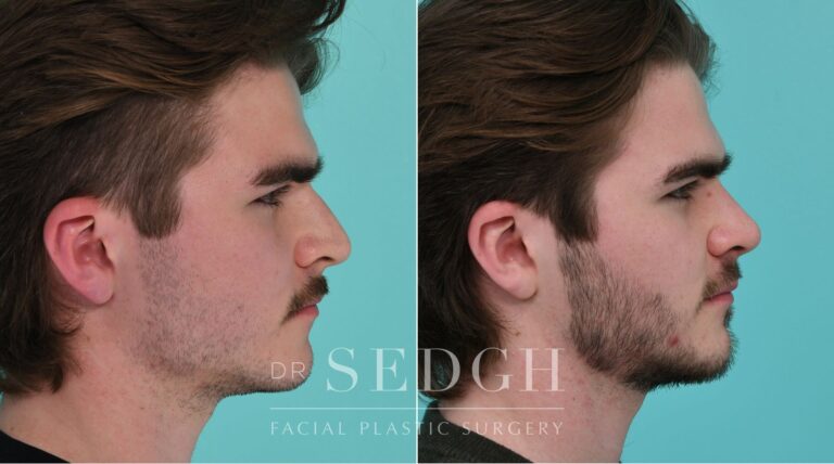 Patient before and after Rhinoplasty | Sedgh