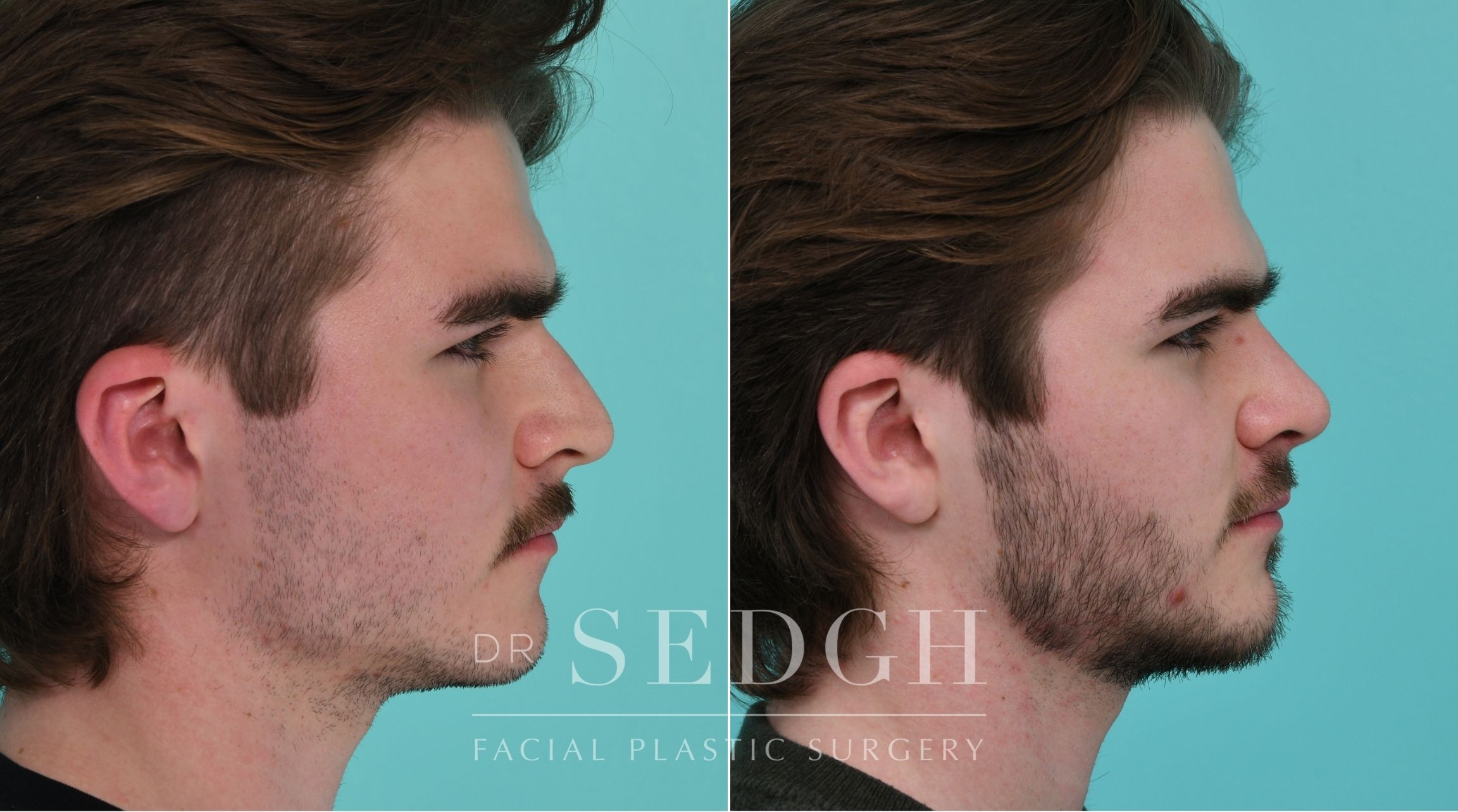 Patient before and after Rhinoplasty | Sedgh