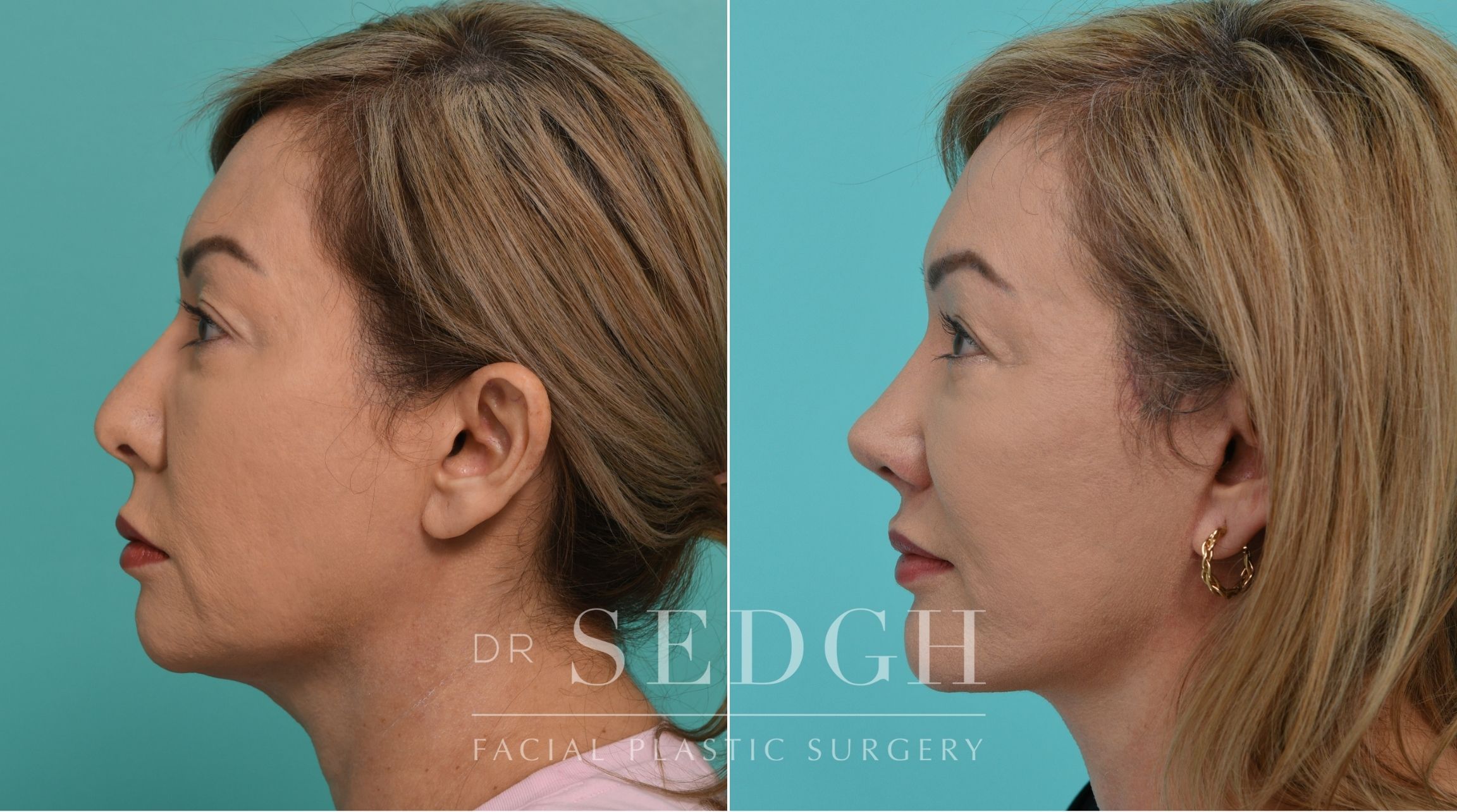 Patient before and after Revision Rhinoplasty, Facelift, and Chin Augmentation | Sedgh