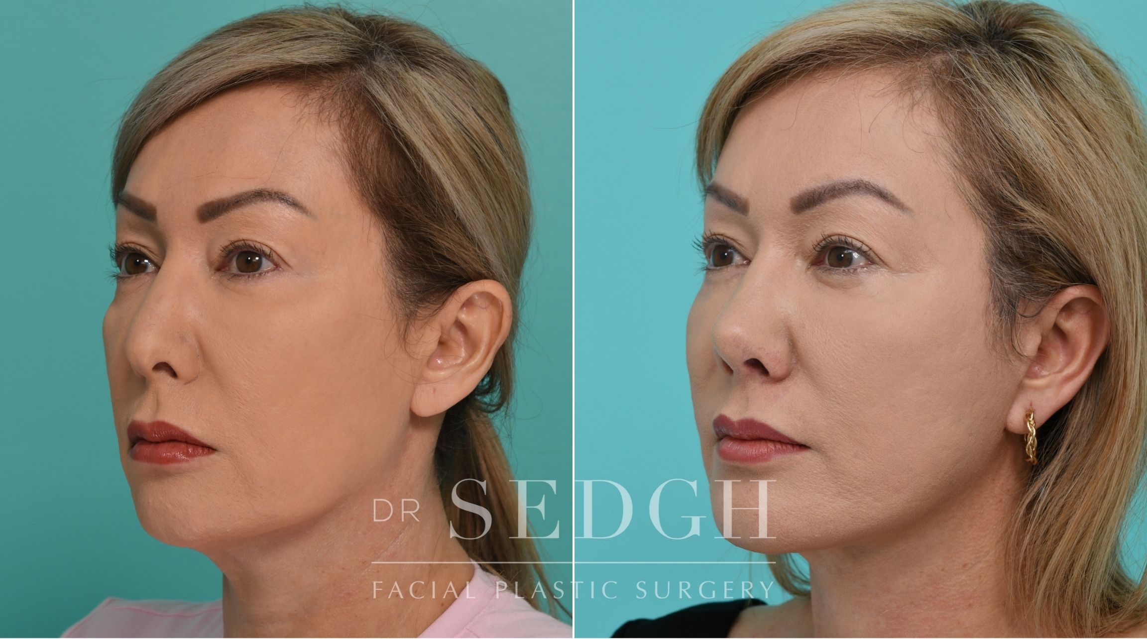Patient before and after Revision Rhinoplasty, Facelift, and Chin Augmentation | Sedgh