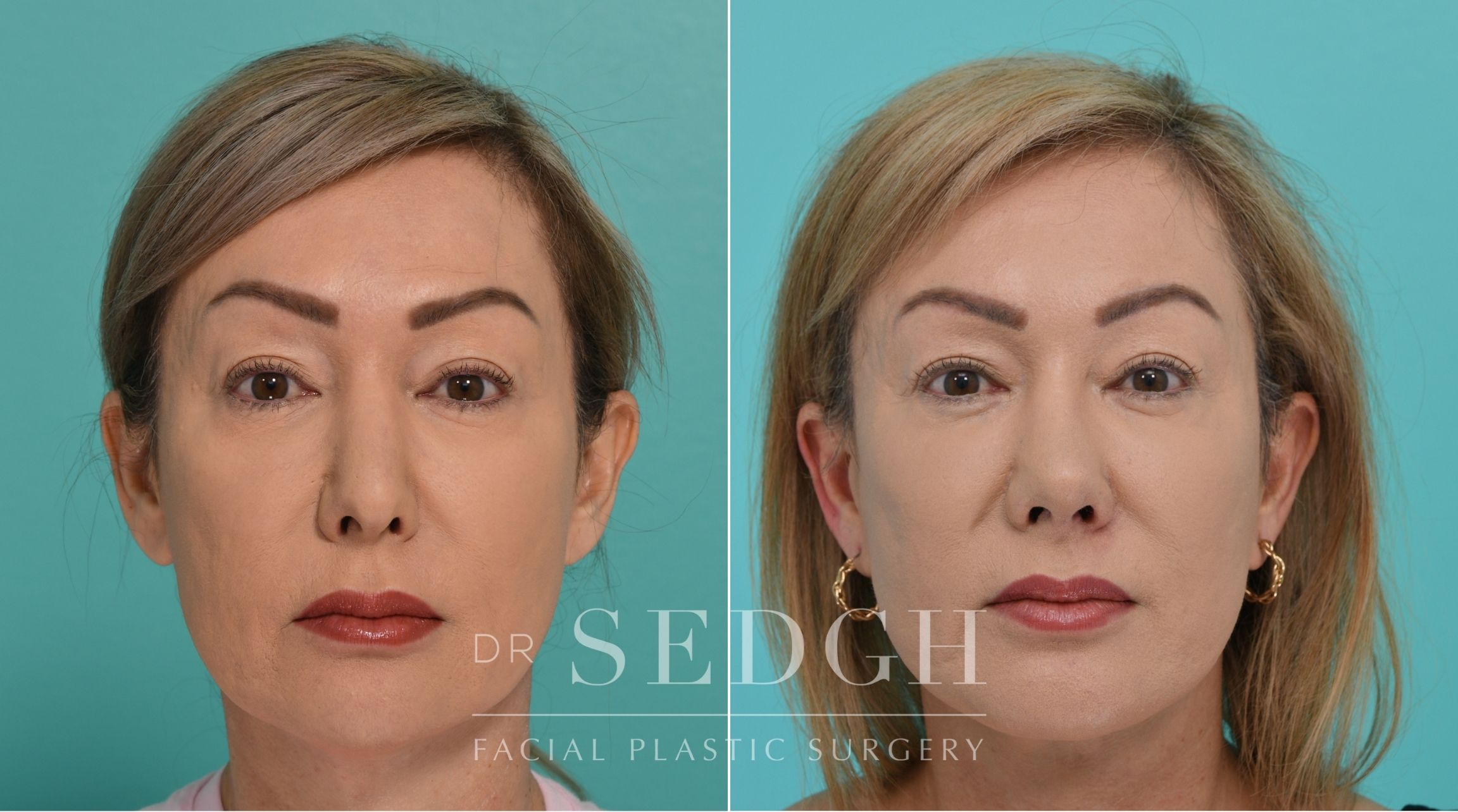 Patient before and after Revision Rhinoplasty, Facelift, and Chin Augmentation | Sedgh