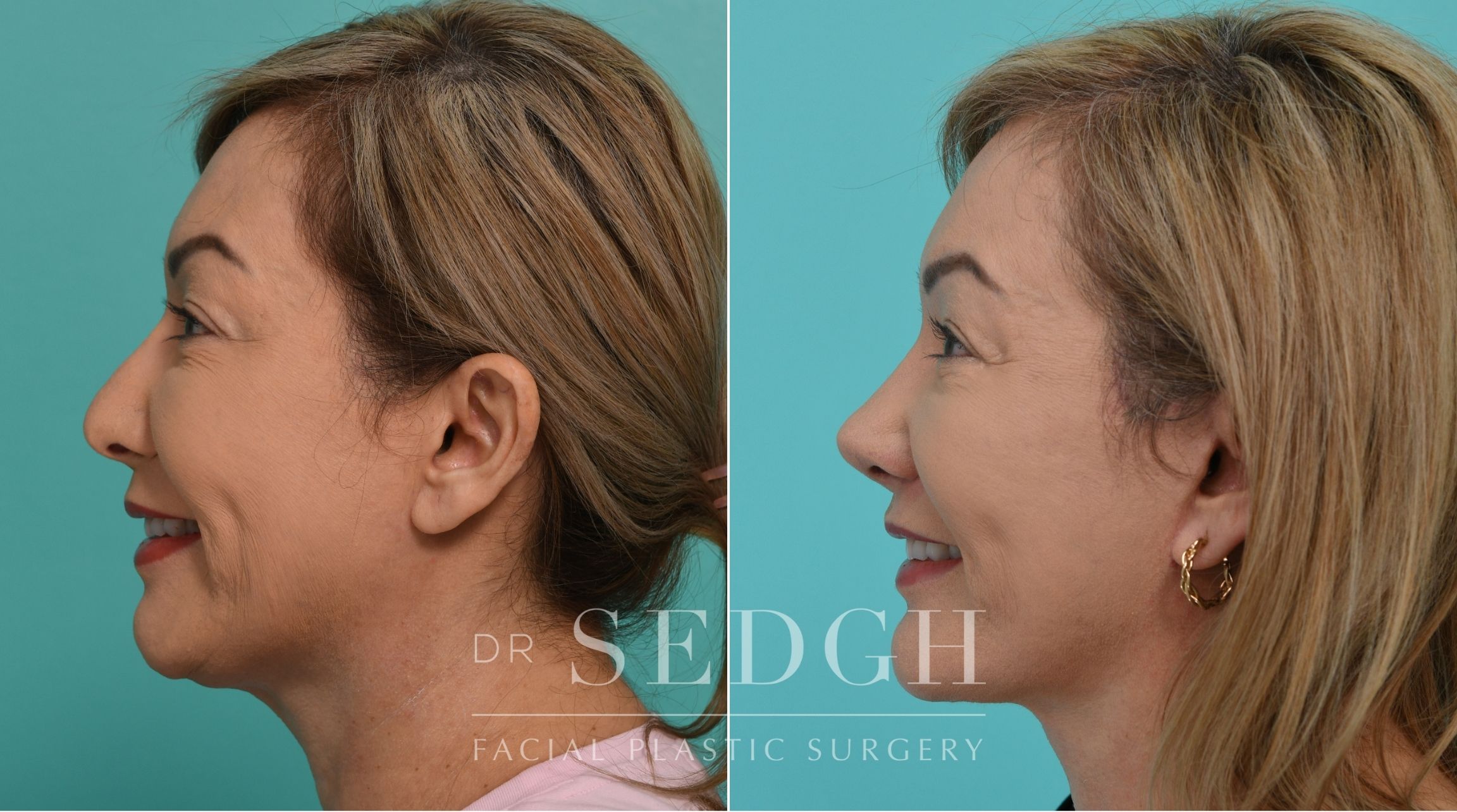 Patient before and after Revision Rhinoplasty, Facelift, and Chin Augmentation | Sedgh